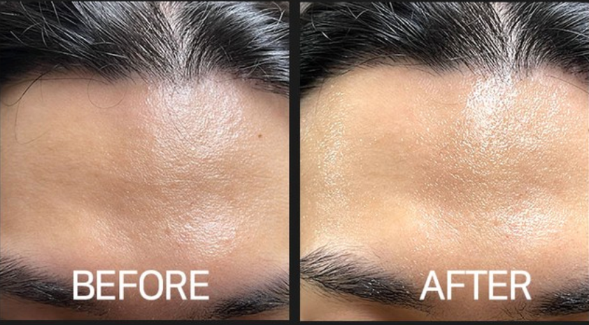 CELLVIO DOLDORI ELECDERMA ROLL MASKE (1 Stk.)